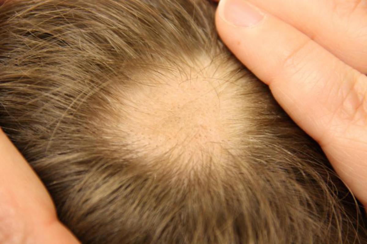 Homeopathy can be the solution for hair loss